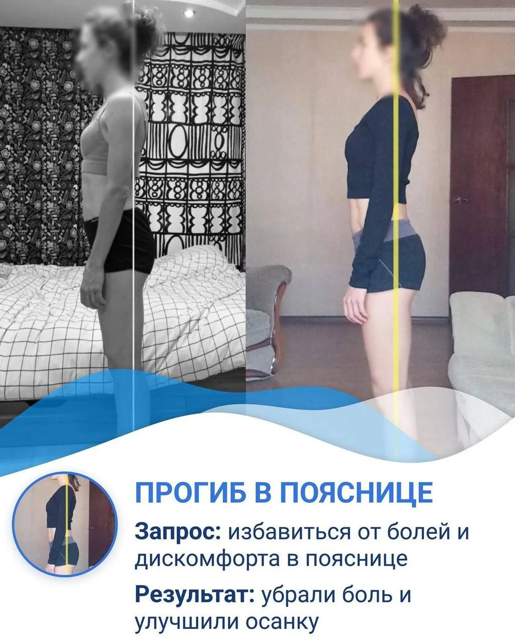 КЕЙС: ПРОГИБ В ПОЯСНИЦЕ

Думаю, каждый из вас хоть раз видел людей, у которых большой прогиб в поясн