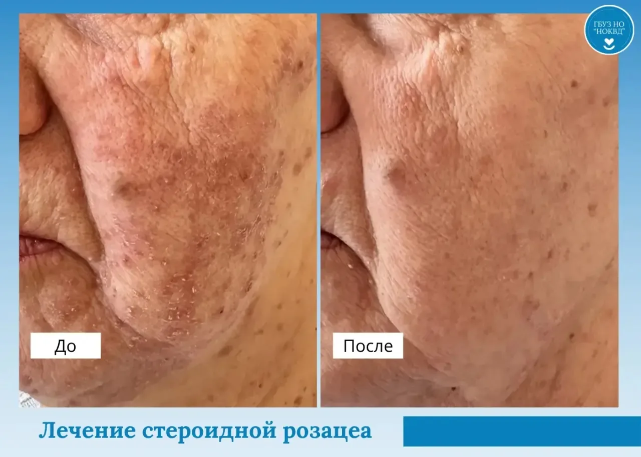 КЛИНИЧЕСКИЙ СЛУЧАЙ

🔹Пациентка длительное время бесконтрольно самостоятельно применяла сильные нару