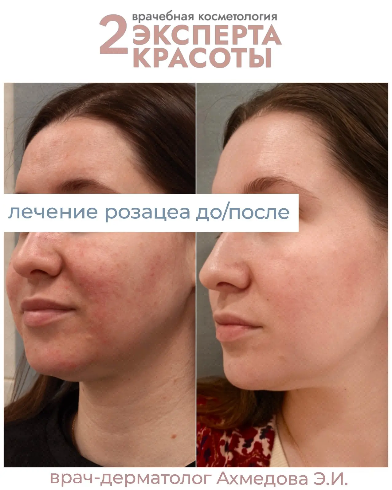 Как мы победили розацию 👏

Ставь + в комментариях ,отправим вам подробности лечения.