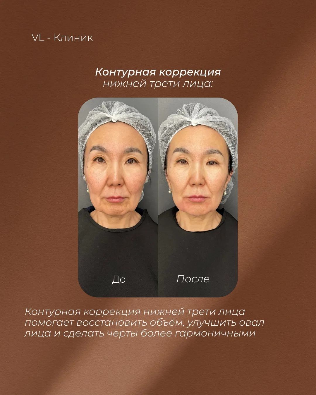 Контурная коррекция нижней трети лица ✨

На фото — результат сразу после процедуры.

С возрастом тка