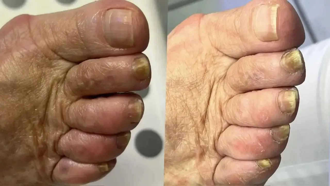 Грибок ногтей — это не приговор. Это диагноз с понятным лечением 🦶🩺 

Признаки, на которые стоит о