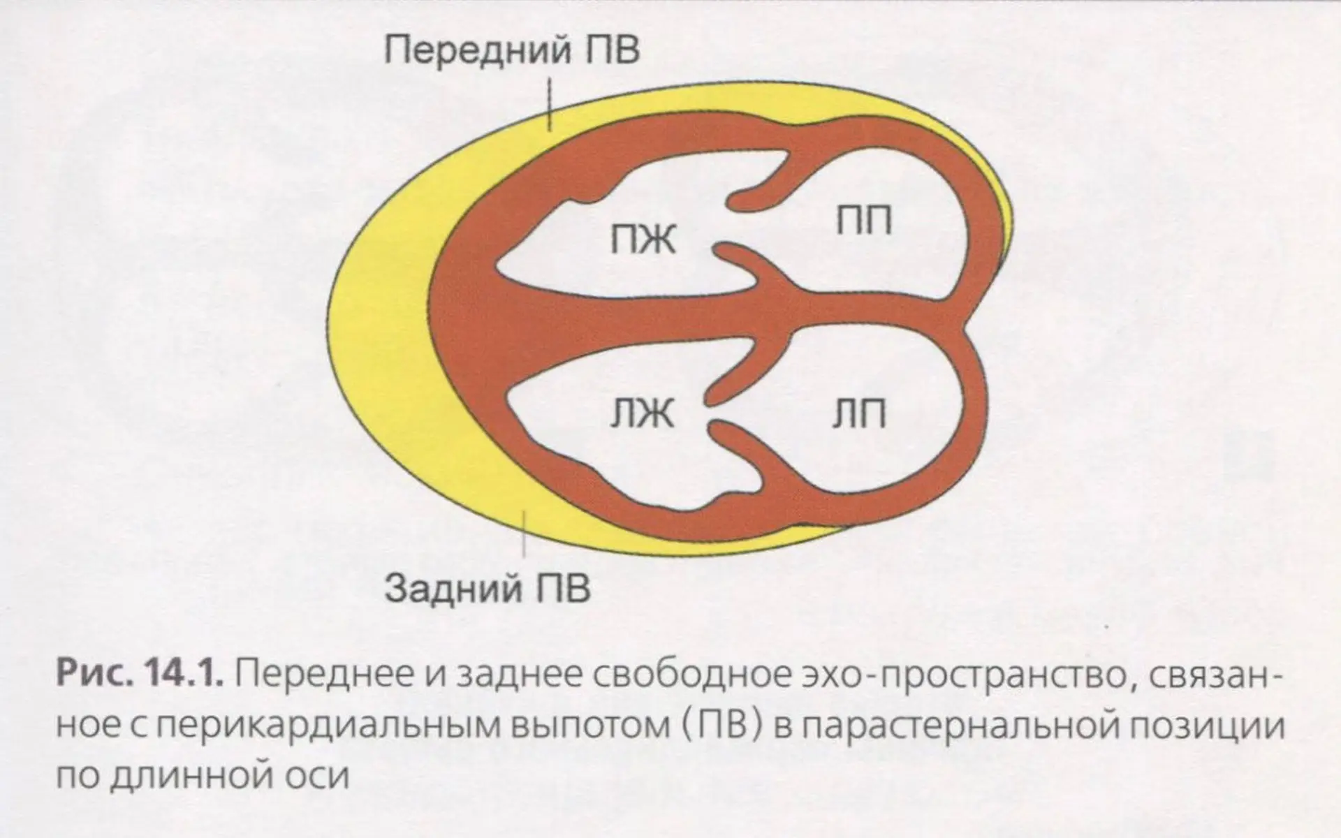 Оценка объема перикардиального выпота при эхокардиографии является полуколичественной и основана на 