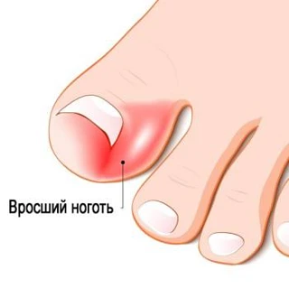 Вросший ноготь 

Самый простой и действующий способ справиться с проблемой — дезинфицирующие ванночк
