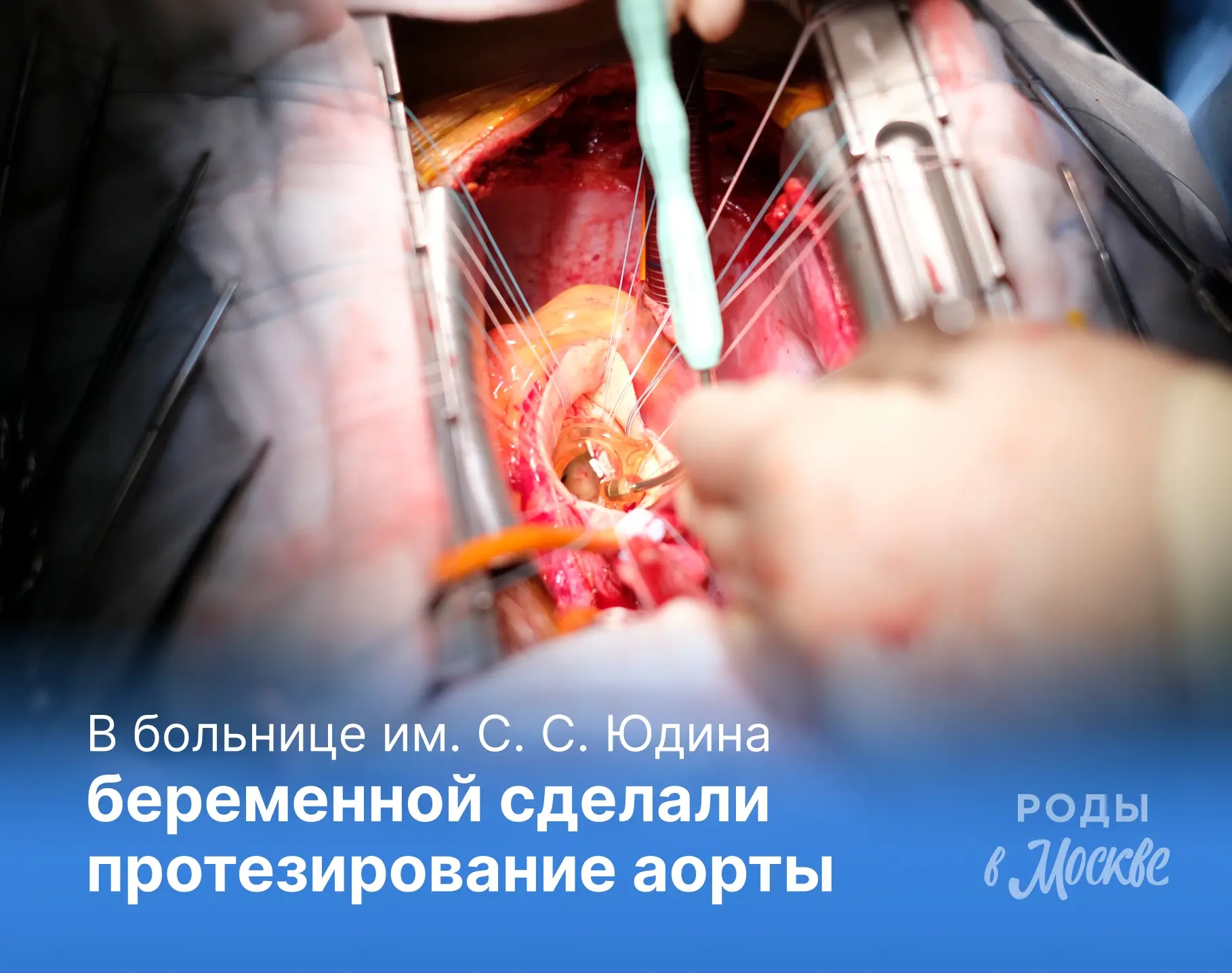 ❕Уникальный случай: беременной провели протезирование аорты

В ГКБ им. С. С. Юдина обратилась береме