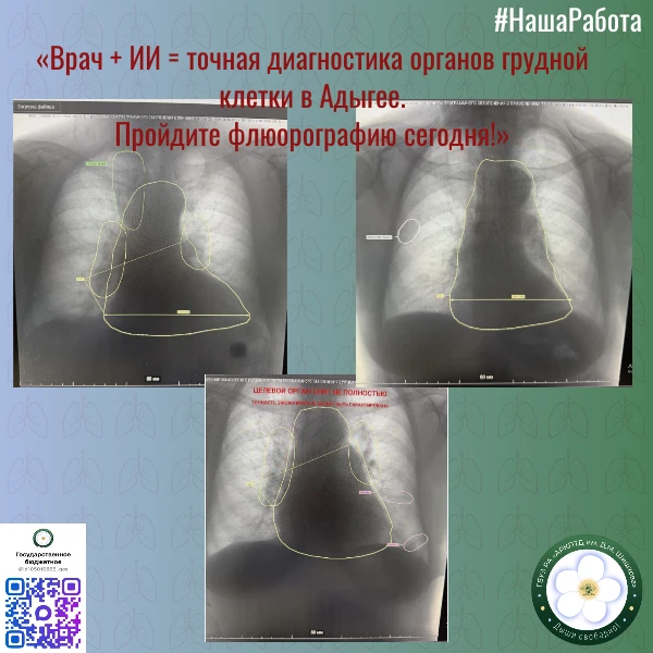 🏥 Цифровые снимки органов грудной клетки в медицинских организациях Республики Адыгея проходят двой