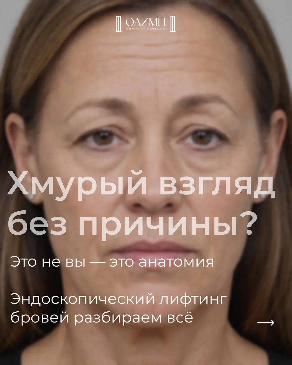 Опущенные брови — это не характер и не настроение. 
Это анатомия, которая со временем меняется. И эт