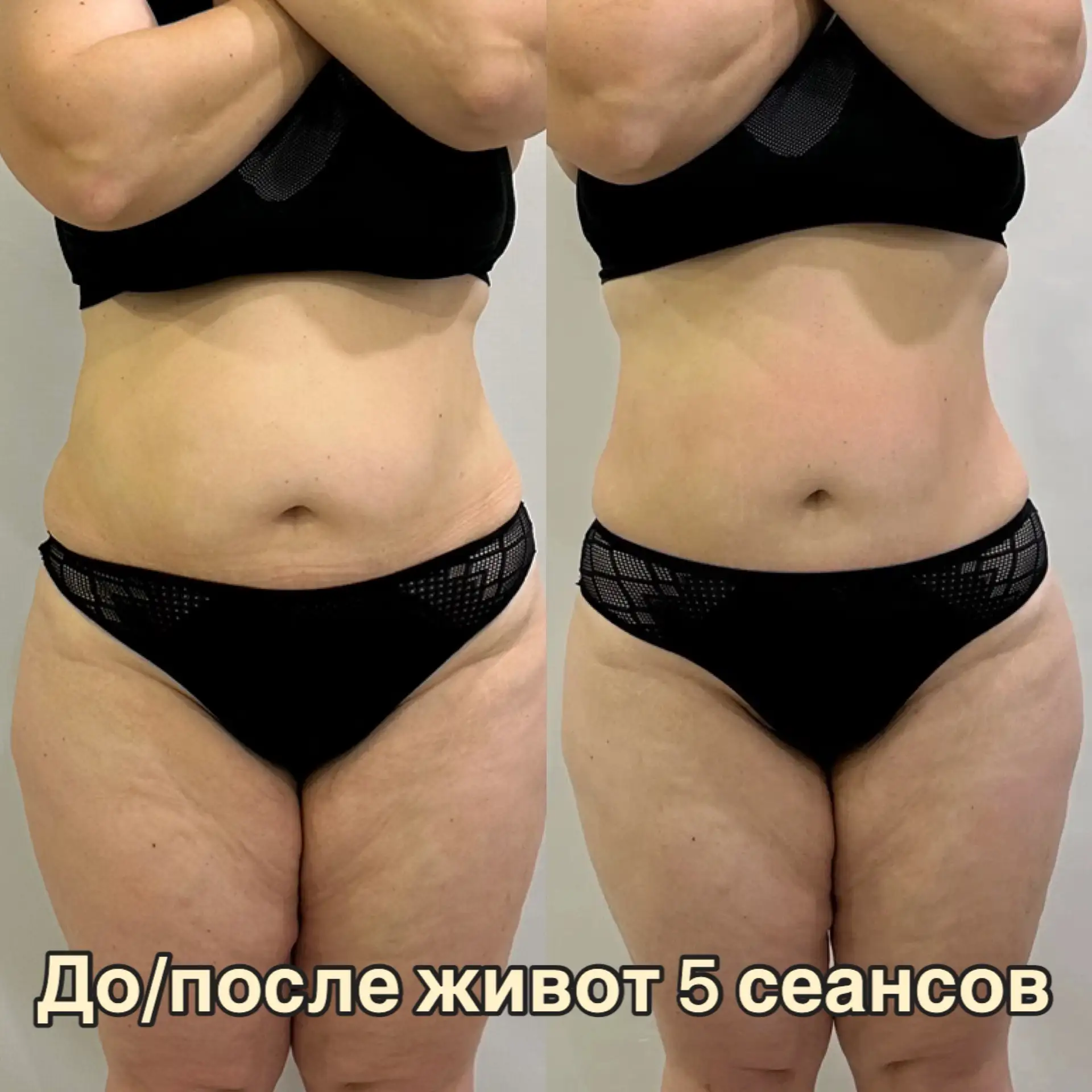 Результат за 1 месяц работы 👆
Показываю результат нашей модели после курса массажа живота.

В течен