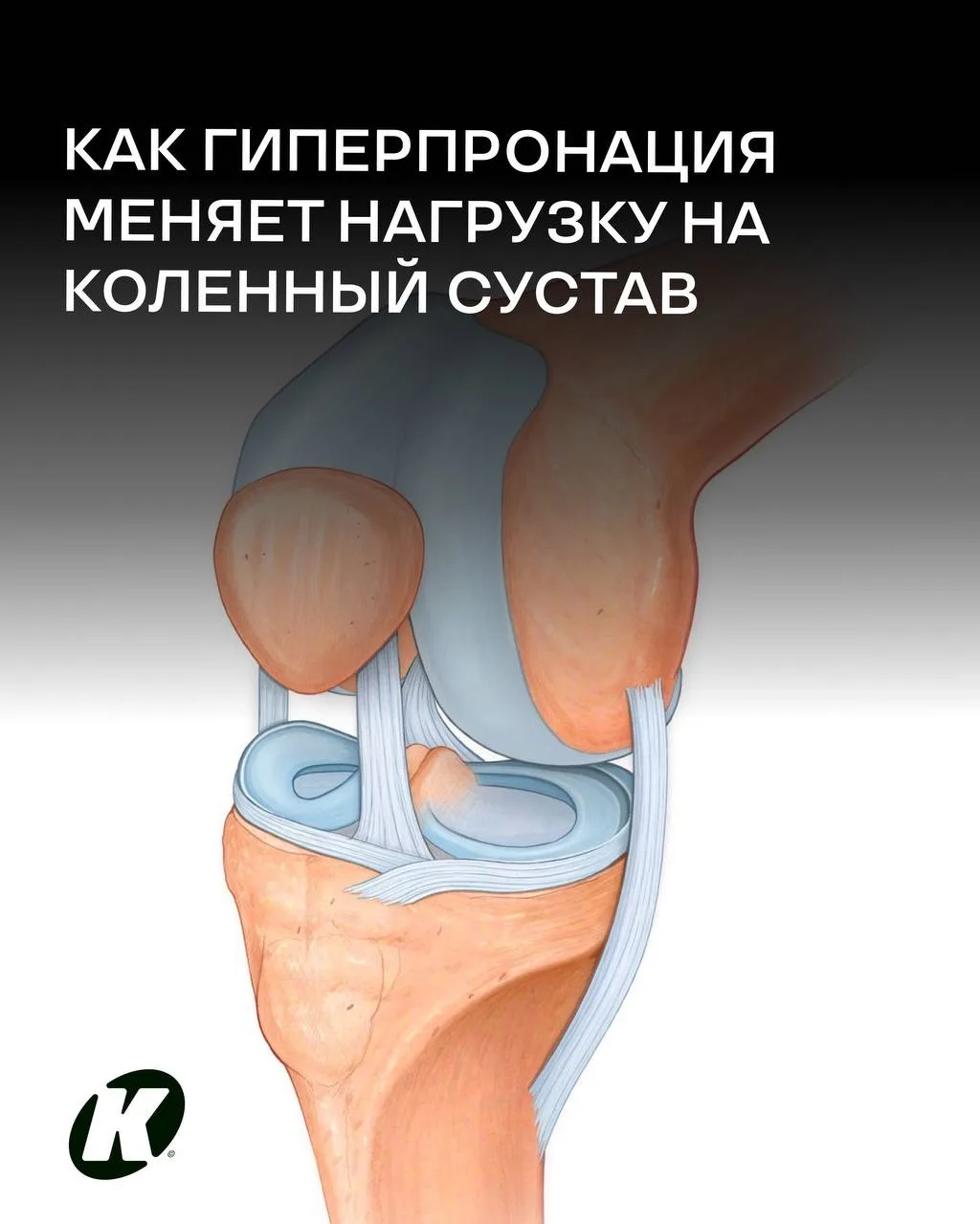 Как гиперпронация меняет нагрузку на коленный сустав

Гиперпронация — это каскад изменений, который 