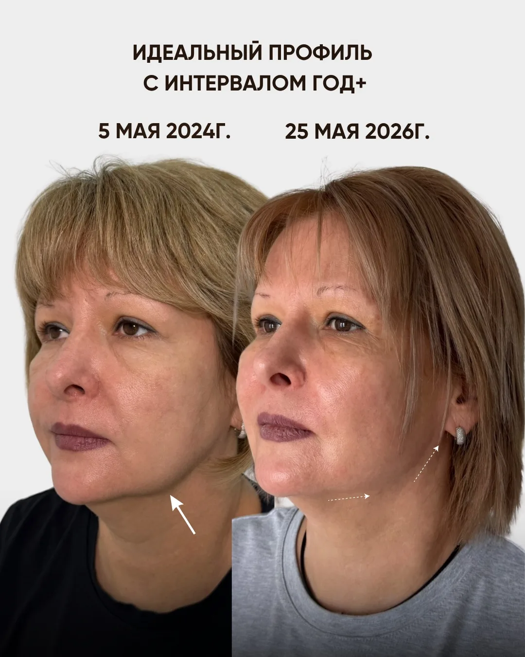Вы часто спрашиваете, как часто нужно повторять процедуру «Идеальный профиль»?

На этих фото пациент