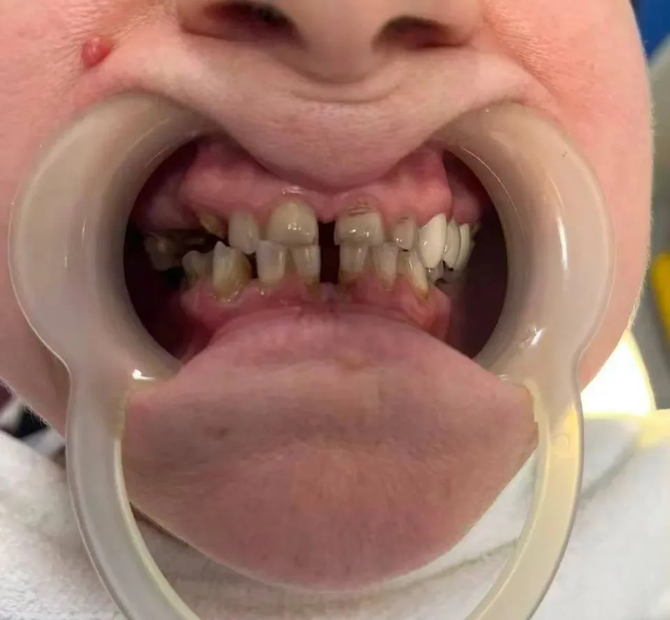 🦷 Сравнение: ДО и ПОСЛЕ протезирования зубов в Китае клиника ДОВЕРИЕ.

Вы всё ещё сомневаетесь, сто