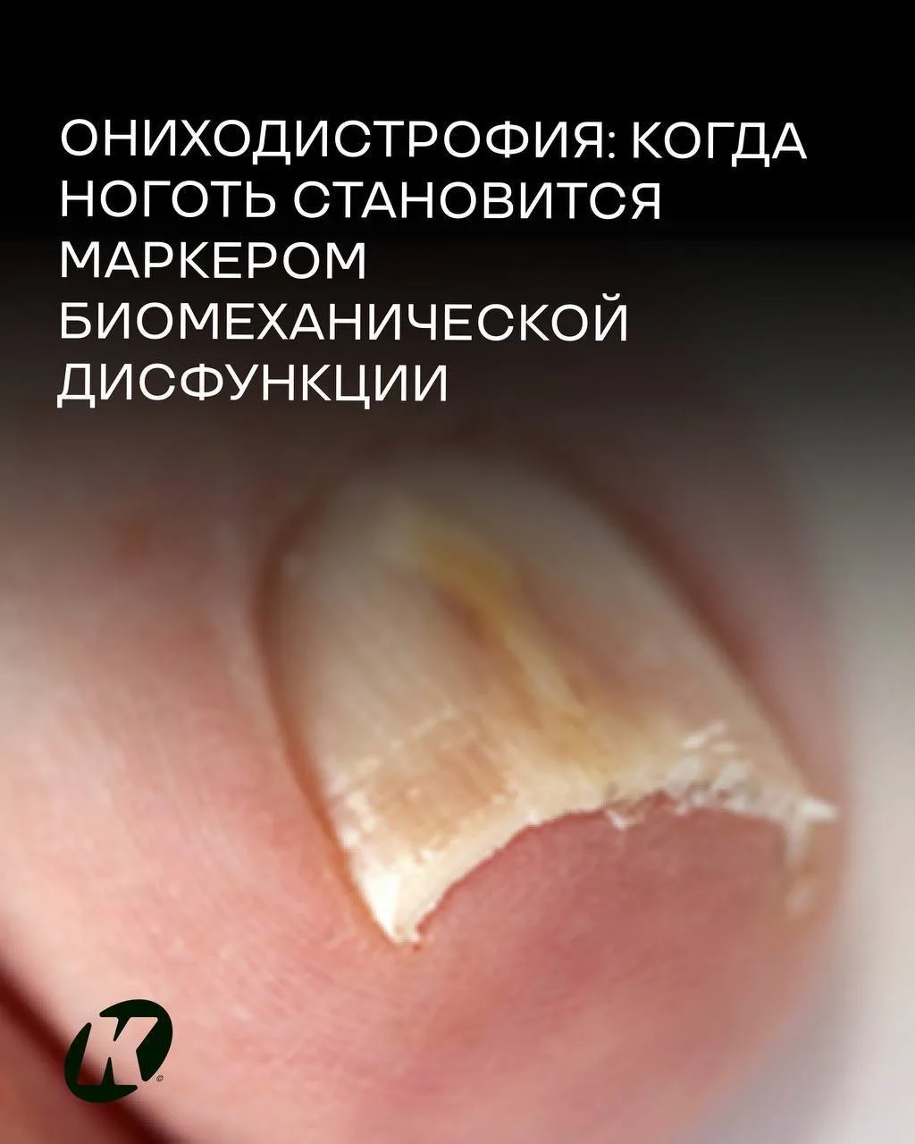 Ониходистрофия: когда ноготь становится маркером биомеханической дисфункции

💬 Как часто в вашей пр