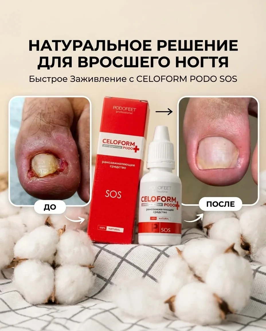 Динамика, которая говорит сама за себя: SOS-серия PODOFEET Professional в работе подологов

Вросший 