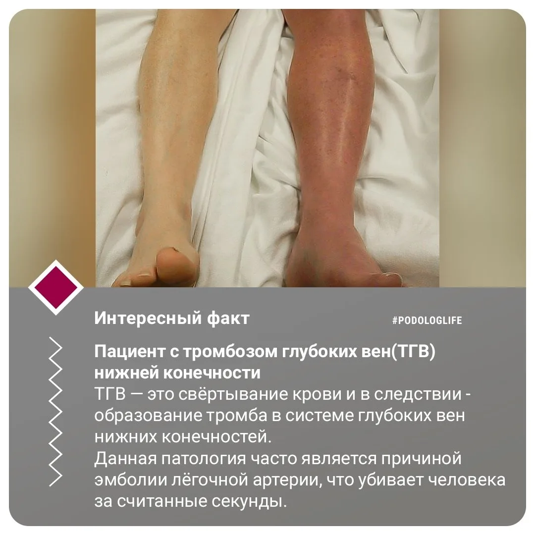 #интересныйфакт #интересныйфакт_подолог #интересныйподофакт