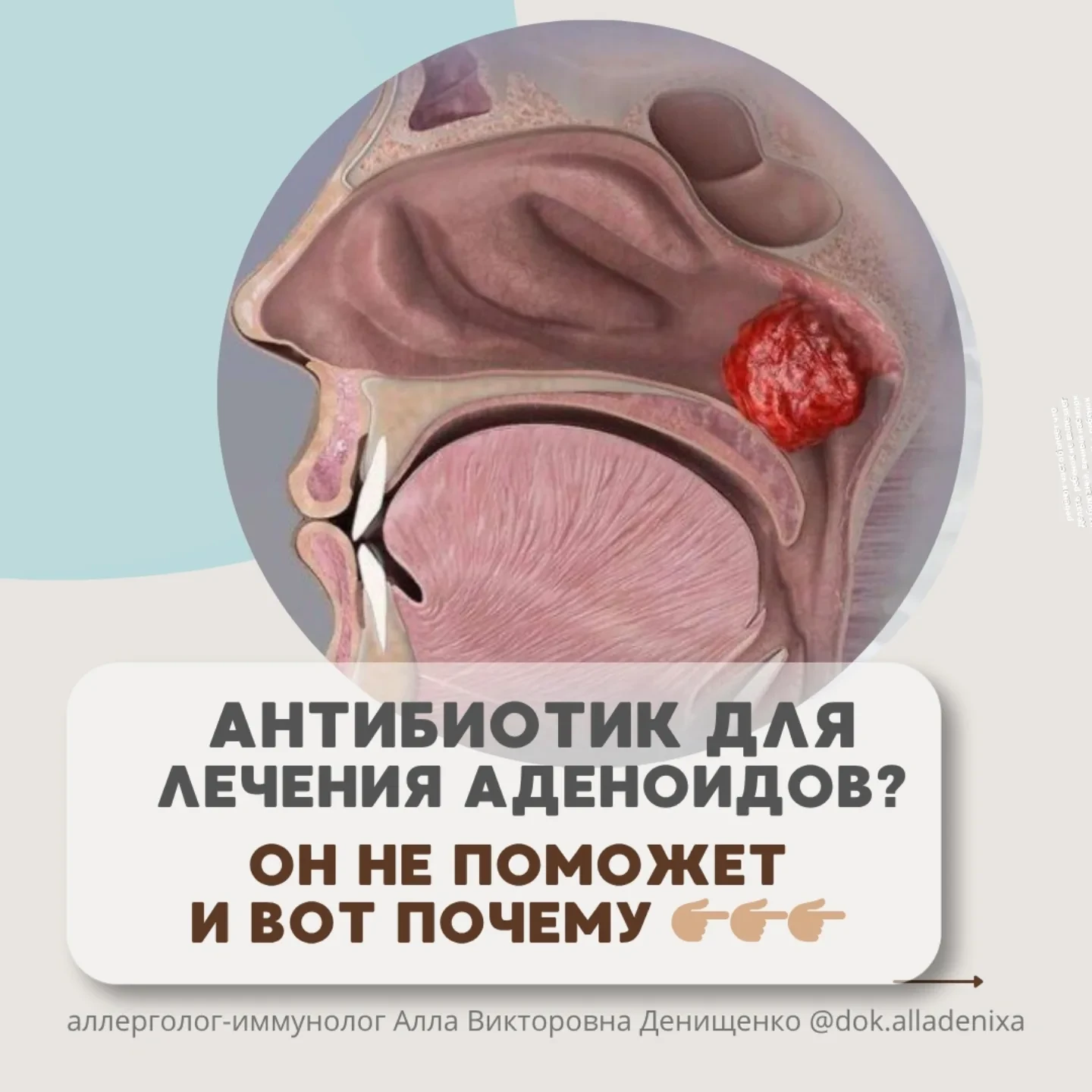 ТРИ КУРСА АНТИБИОТИКОВ ЗА ГОД У РЕБЕНКА, в том числе в виде спрея для носа?
А АДЕНОИДЫ ВСЁ РАВНО РАС