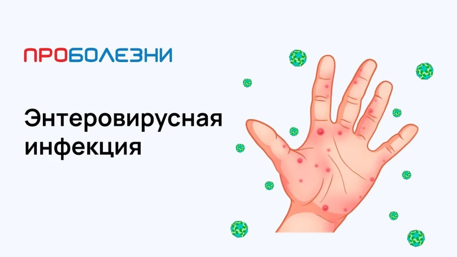 Энтеровирусная инфекция (ЭВИ) — группа острых инфекционных заболеваний, вызываемых энтеровирусами ро