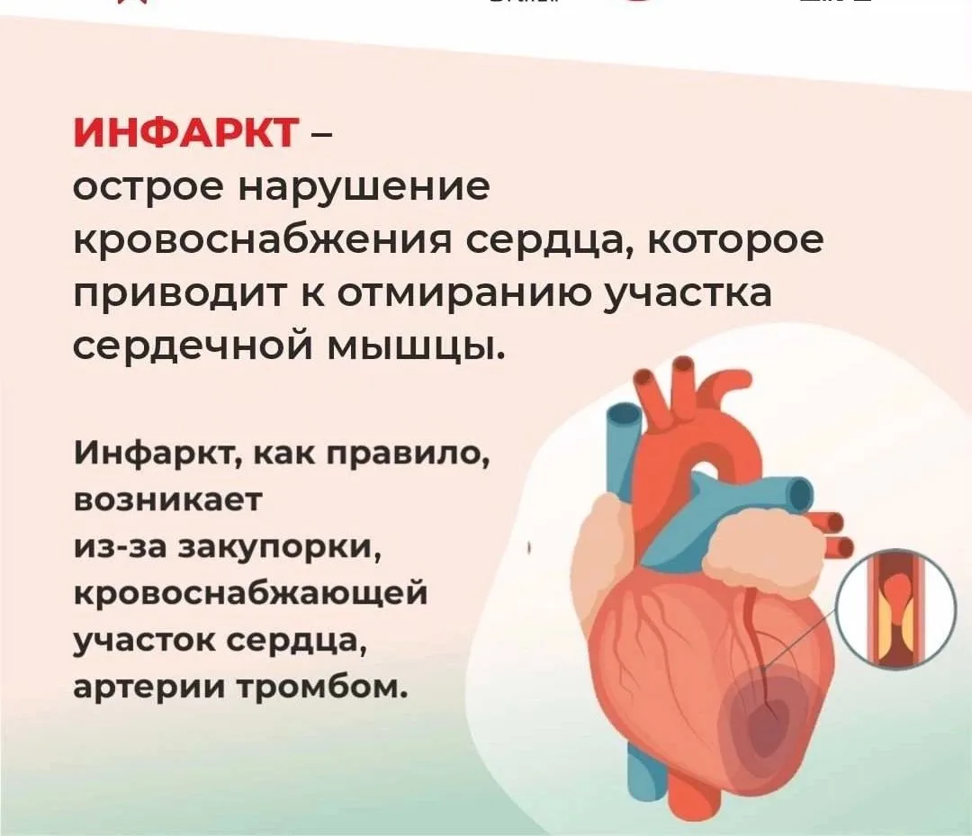 Инфаркт не всегда кричит о себе классической болью в груди. Иногда его симптомы так маскируются, что