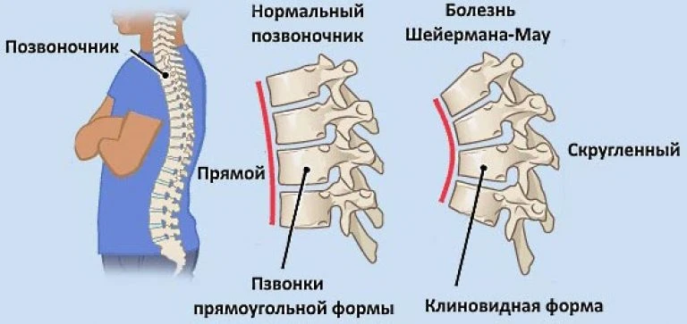 Привет друзья!👋

Сегодня обсуждаем тему нарушения осанки  - гиперкифоз грудного отдела и его патало