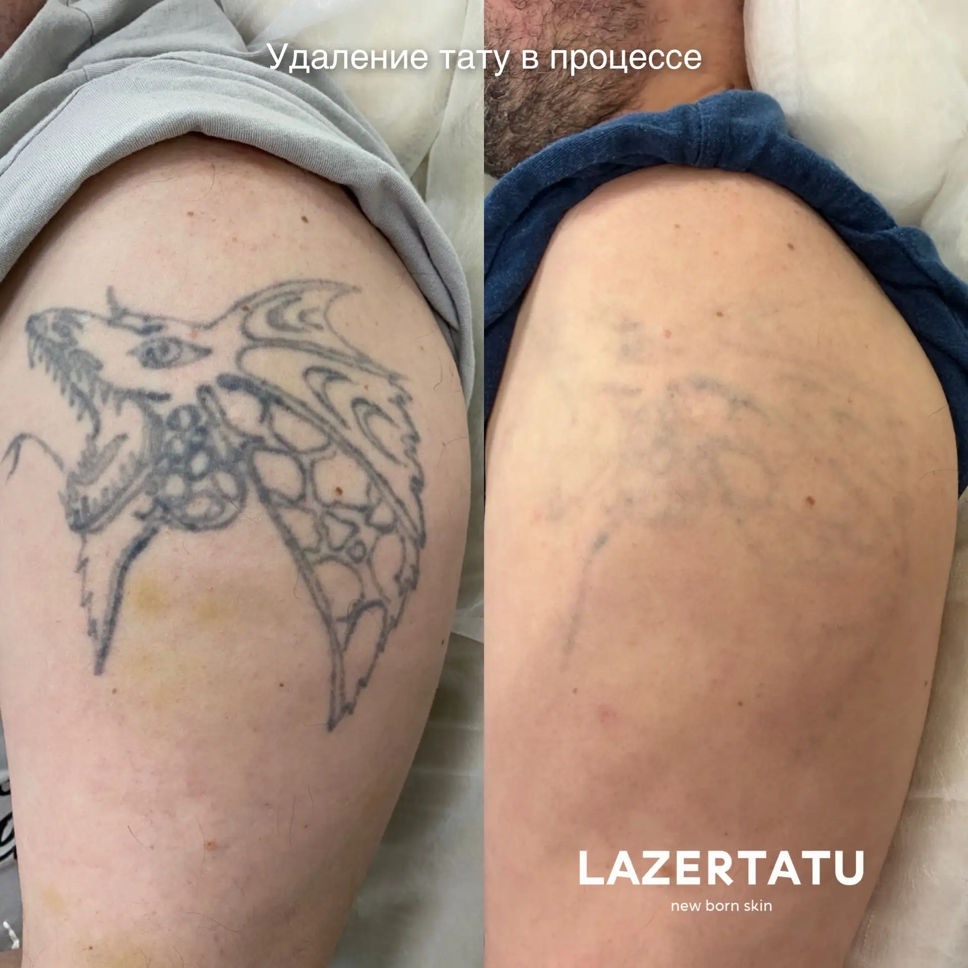 Удаление тату до чистой кожи 🔥 
Осветление под перекрытие 👍🏻 
2 студии 🤗 Норильск, Талнах 

Онла