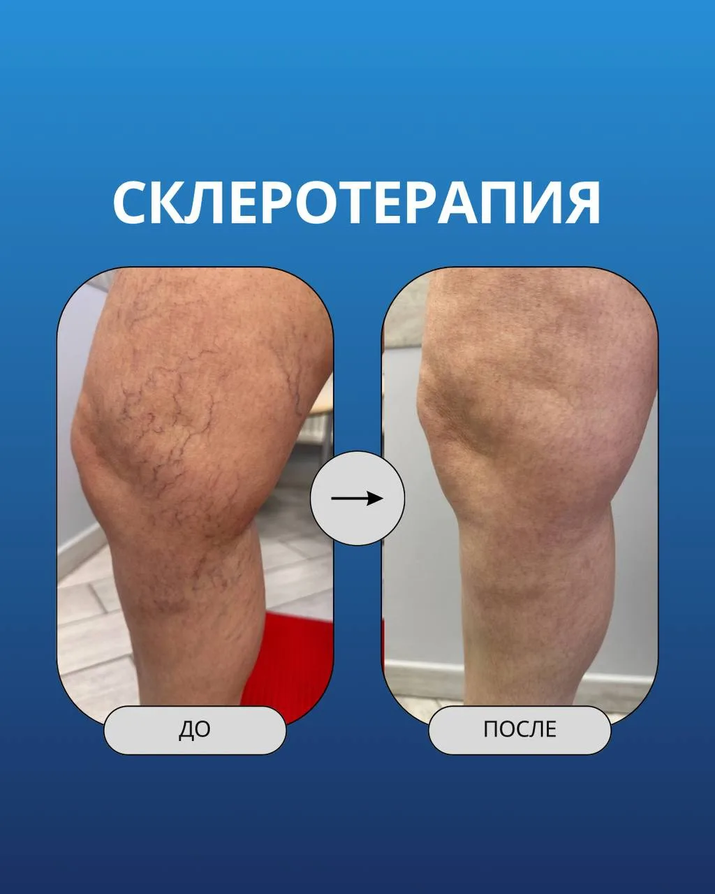 Иногда пациенты приходят с одной мыслью: «Я хочу просто убрать некрасивые венки».
Но за этим иногда 