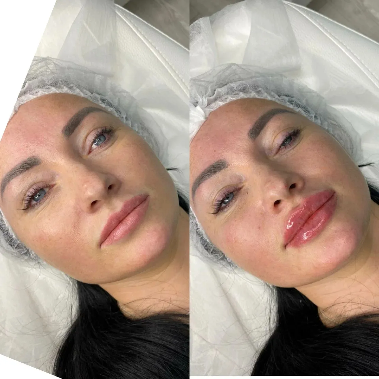 Только 23 и 24 июня
💋⭐
Комплекс Full Face БОТОКС + губы: платите только за стоимость препаратов, ра