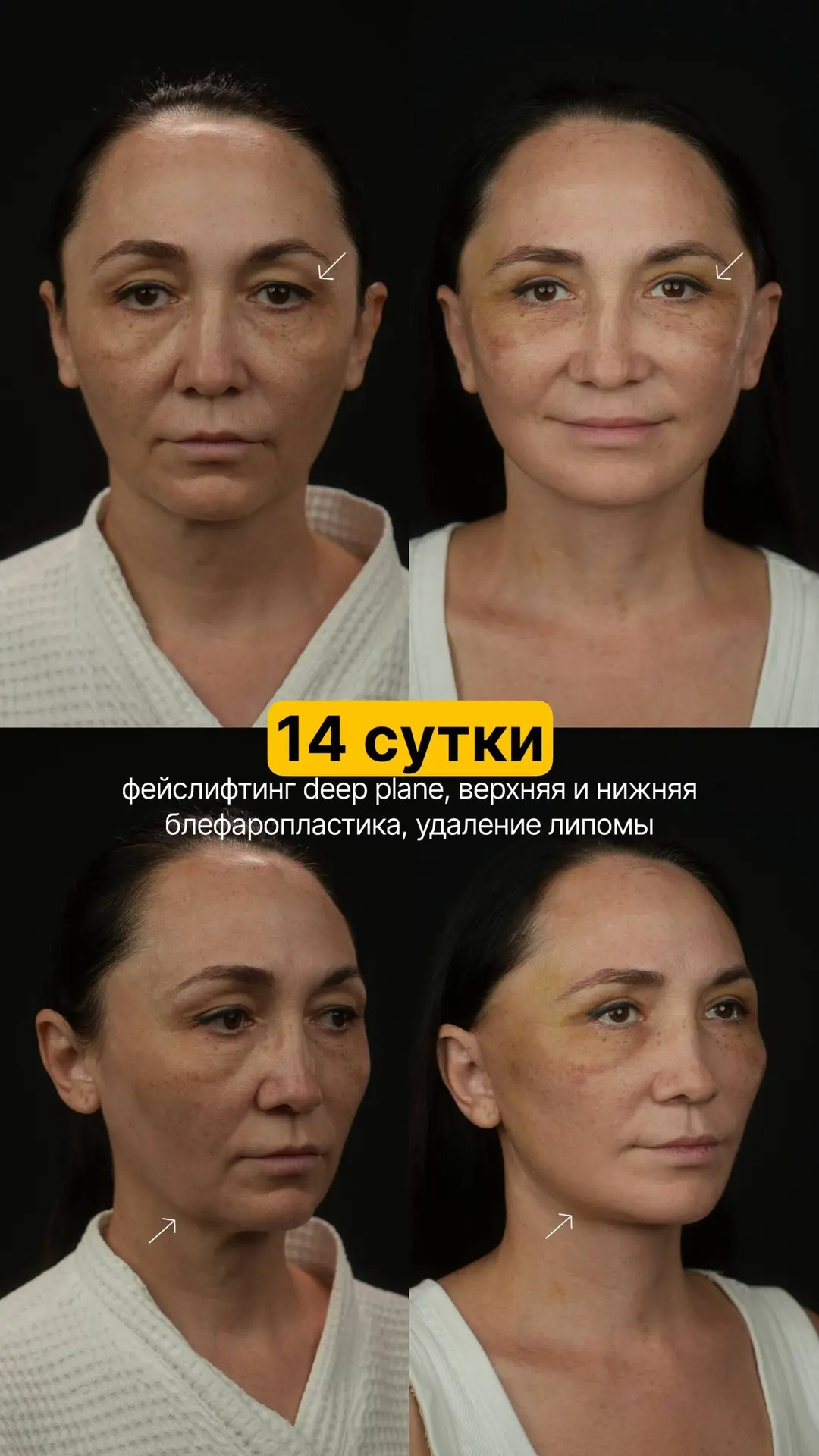 14 сутки после большой комплексной операции.

Что мы делали? Теперь считаем на пальцах 🤣  : фейслит