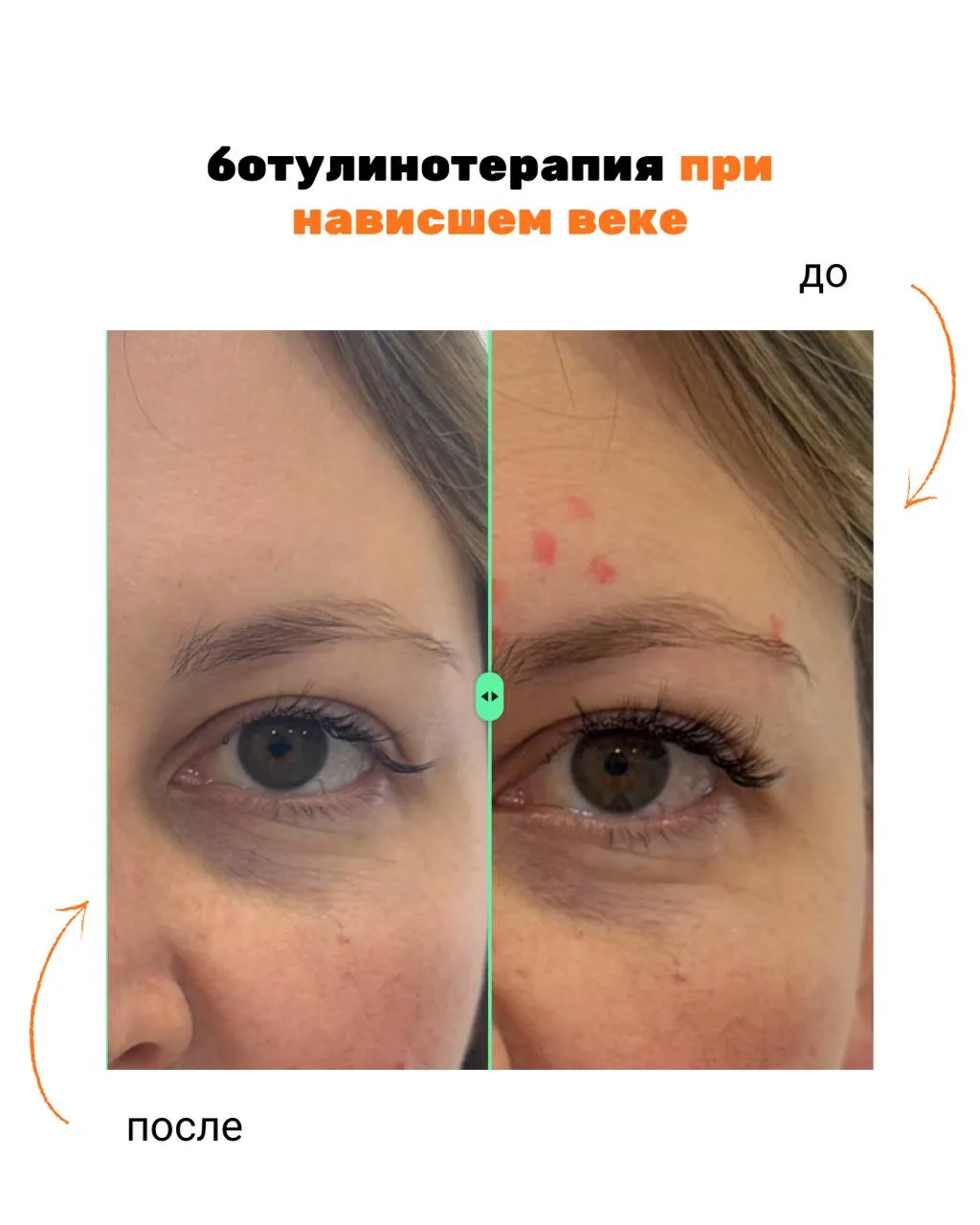 Без фильтров и фотошопа.
Проведена ботулинотерапия в методике, по которой я работаю (когда корректир
