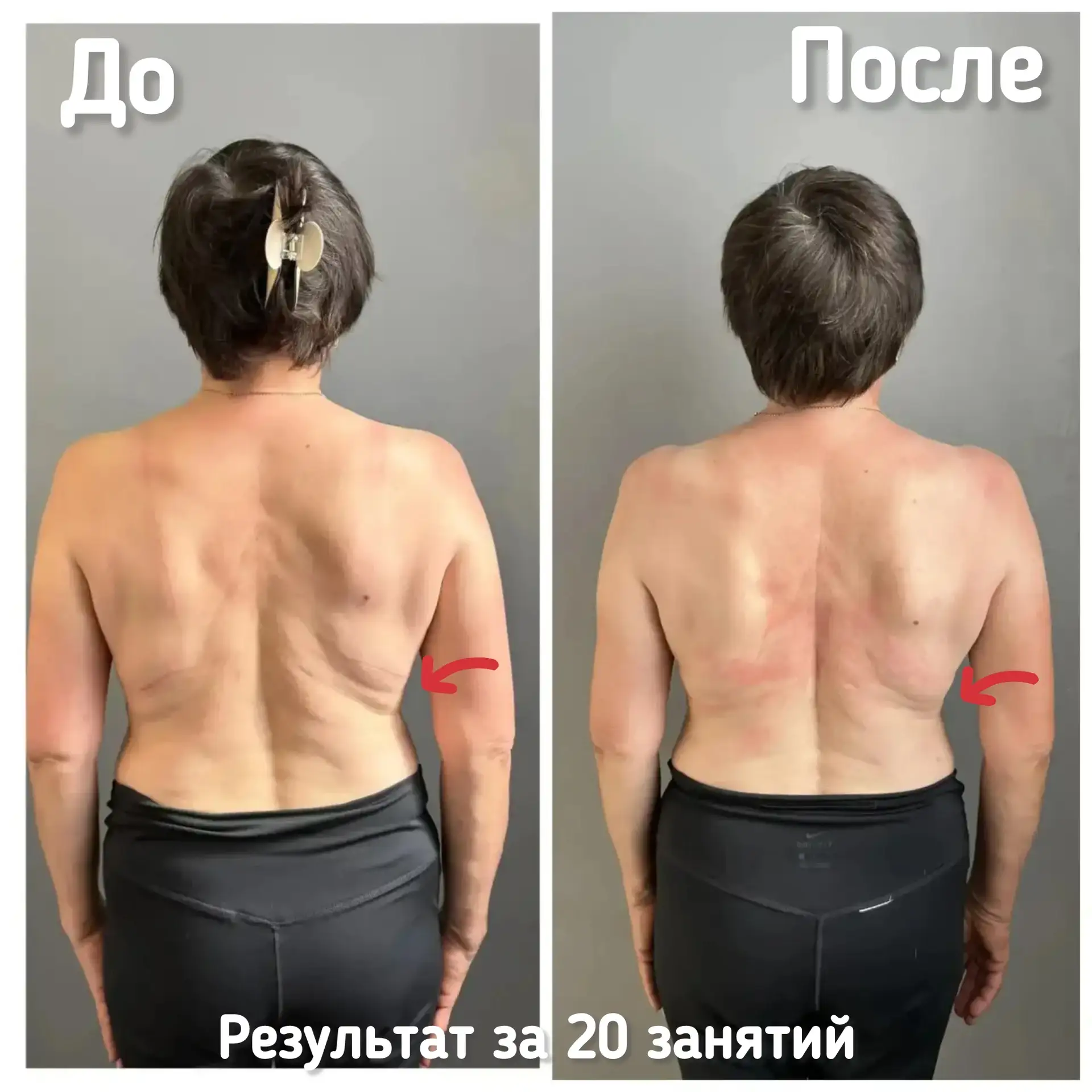 Представляем Вашему вниманию результат женщины (67 лет ) за полный курс 🔥🔥🔥
✅Корпус стал ровней ,