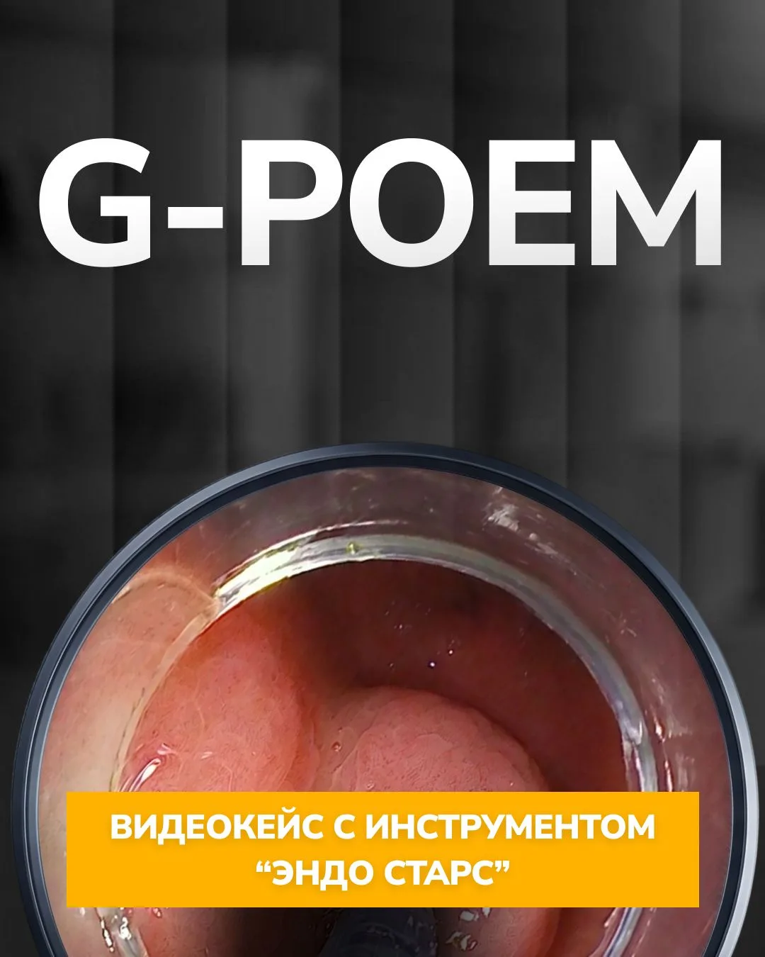 G-POEM | Видеокейсы Эндо Старс 

Уважаемые коллеги,

Представляем клинический случай эндоскопической