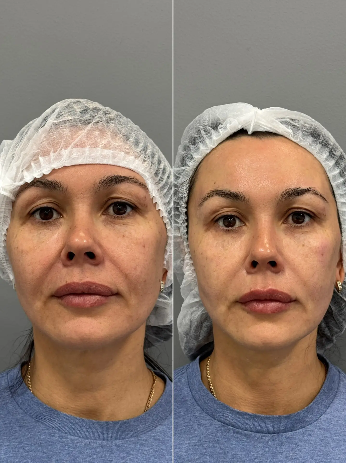 #до_после_mosinaclinic 
Замечаете, что овал лица стал менее чётким, появились брыли, а носогубные ск