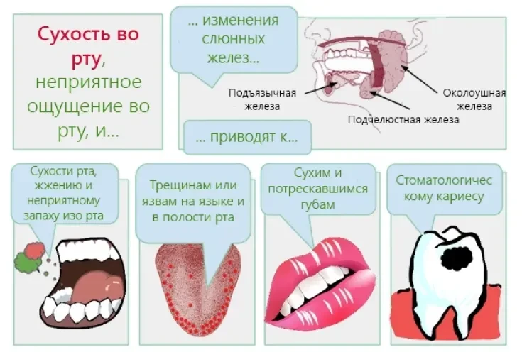 Сухость во рту (ксеростомия): причины и как помочь.
Сухость во рту, известная в медицине как ксерост