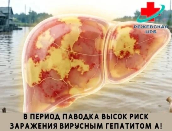 В период паводка высок риск заражения вирусным гепатитом А!
🧪 Что это за болезнь? Гепатит А — остро