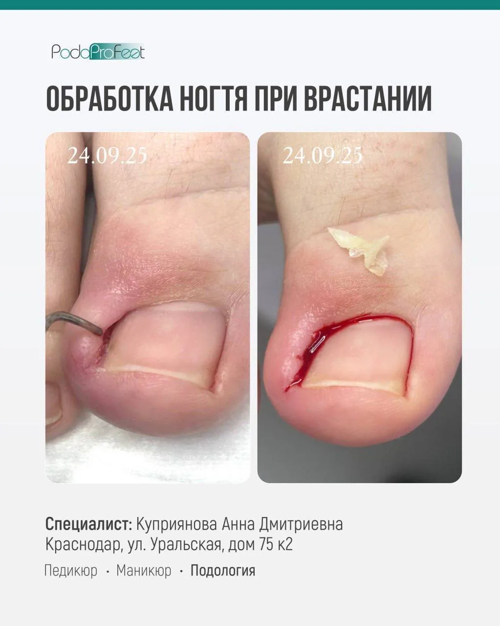 Удалили вросший сигмент, а что дальше?

Один из самых частых случаев в кабинете подолога: клиент при