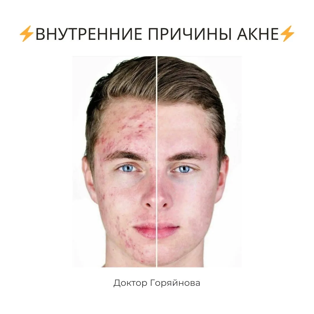 ⚡️ВНУТРЕННИЕ ПРИЧИНЫ АКНЕ⚡️

🔺Гормоны 

Мужские половые гормоны (тестостерон и его активные метабол