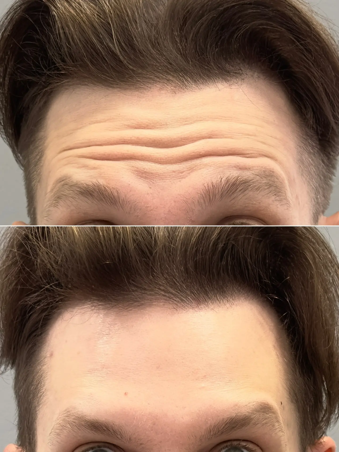 #до_после_mosinaclinic 
Full Face ботулинотерапия — одна из эффективных методик, потому что она позв