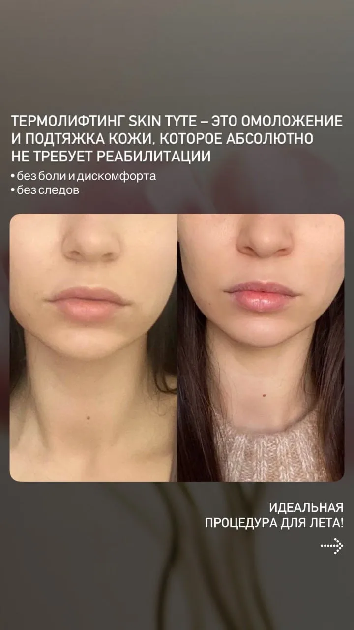 Подтянутая, гладкая, красивая кожа ЛЕТОМ 🍋

Термолифтинг Skin Tyte приводит кожу в тонус, разглажив
