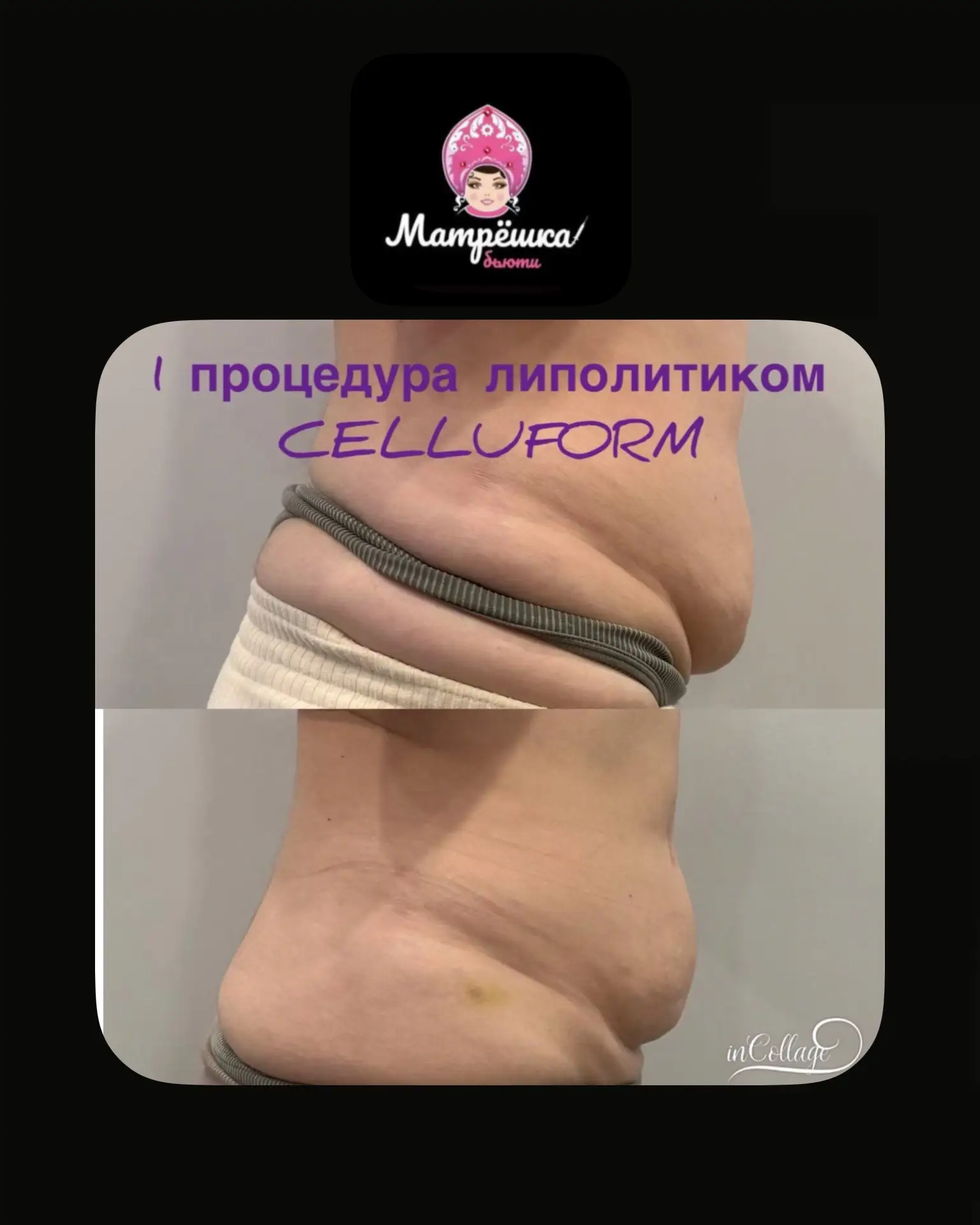 Коротко и по делу: 

липолитики для тела – это не способ «похудеть за один укол», а эффективный инст