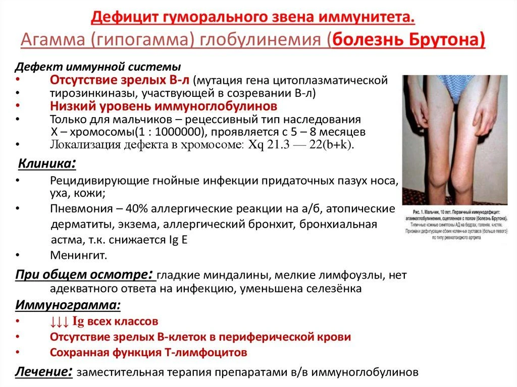 Болезнь Брутона