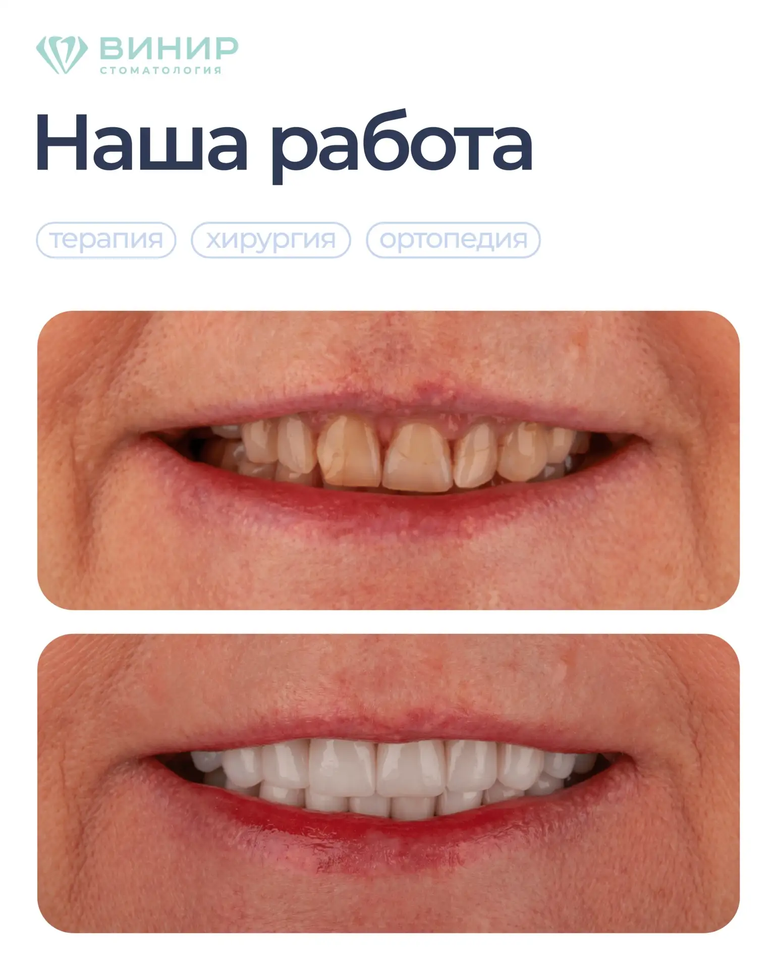 💎КЛИНИЧЕСКИЙ СЛУЧАЙ💎

С радостью делимся новой работой команды наших врачей!

🔹 В стоматологии сл