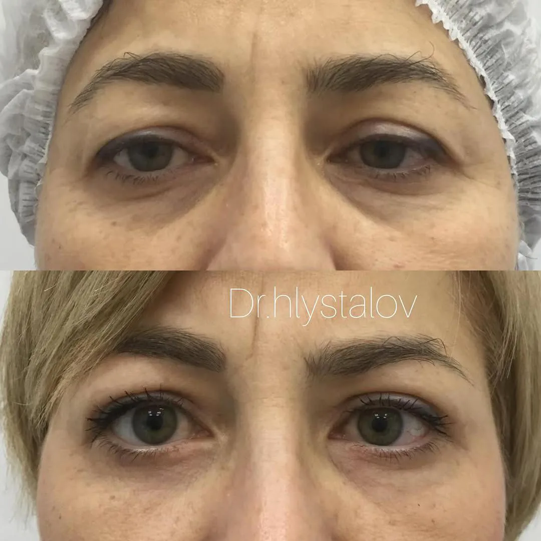 👁️ На фото наша прекрасная пациентка, которой была выполнена круговая блефаропластика (пластика вер