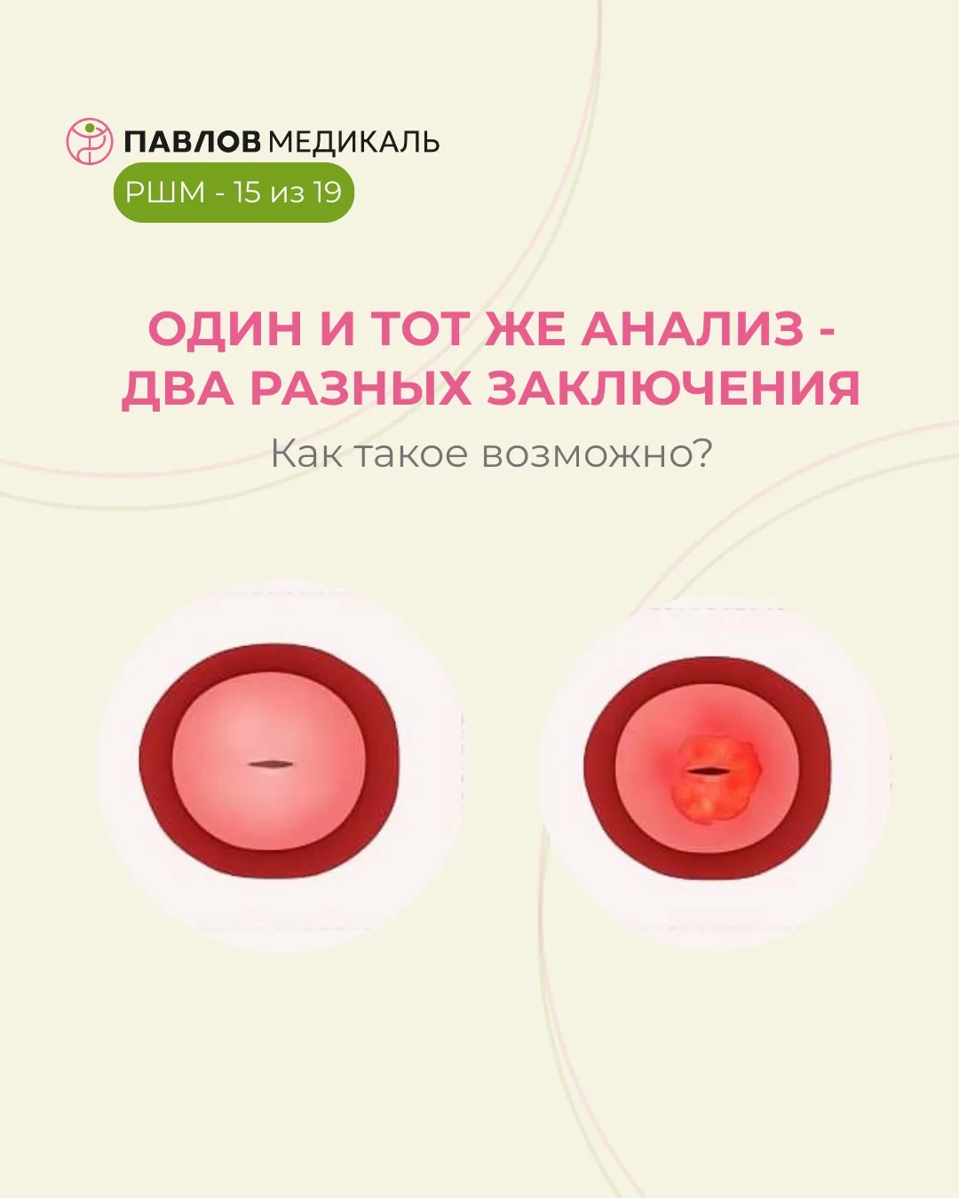🟢Диагностика и лечение заболеваний шейки матки. Часть 15 из 19

Очень важно— чтобы цитологические, 