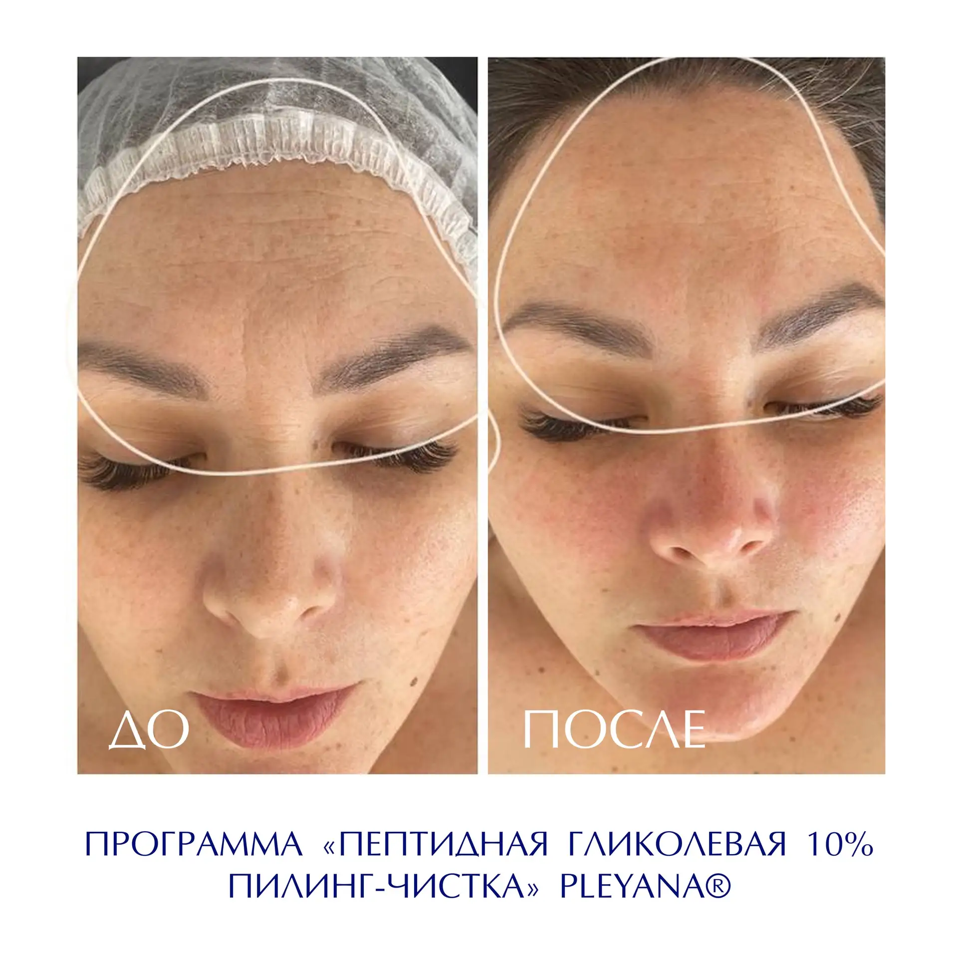 До/после 💙

ПРОГРАММА «Пептидная гликолевая 10% пилинг-чистка» 

Автор работы: Топалова Марина Самв