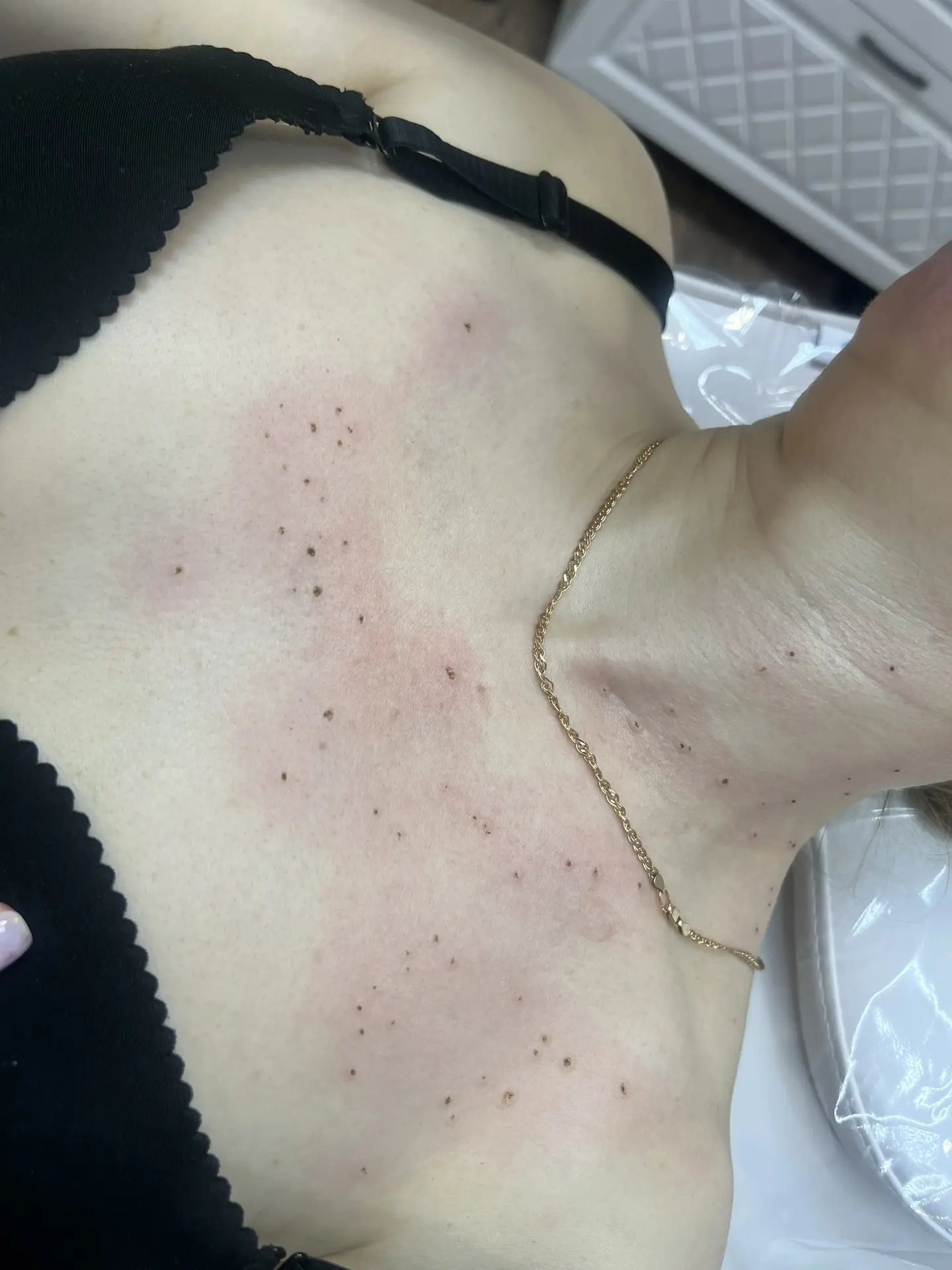 Зачем удалять папилломы и кератомы?
Не все новообразования требуют удаления, но есть чёткие показани