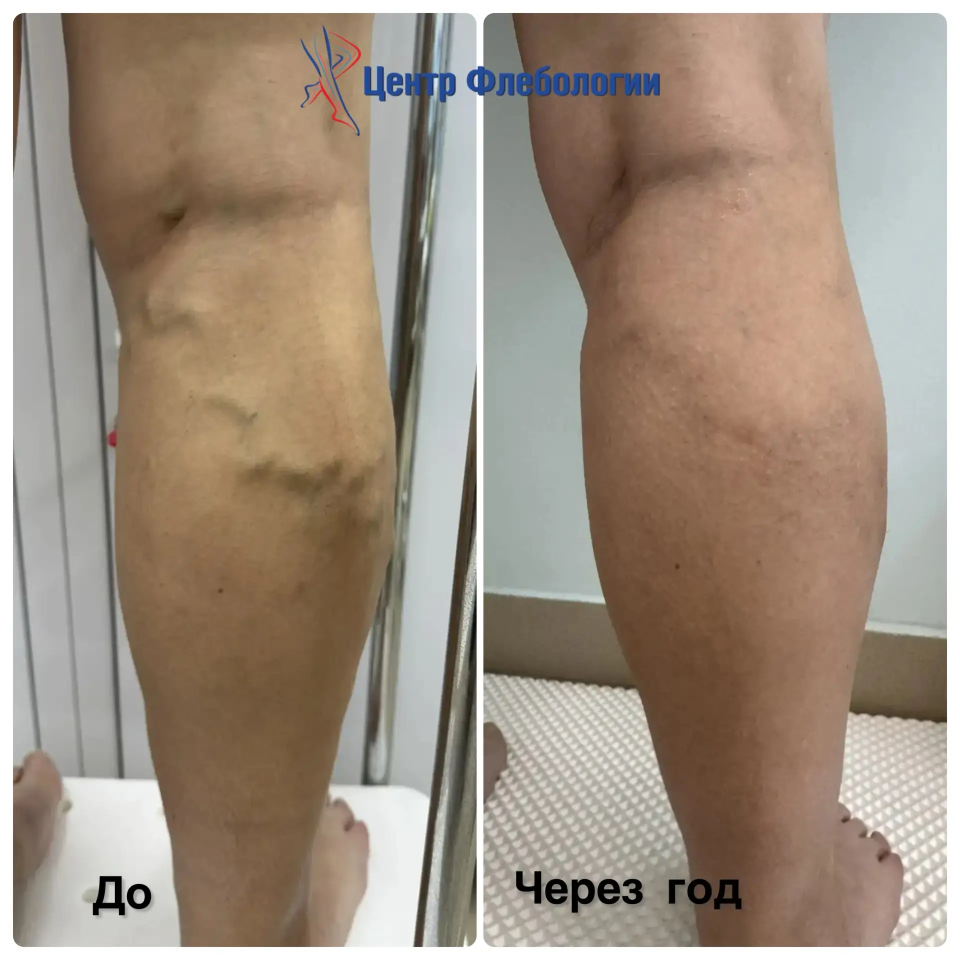 🗓️Пациентка 56 лет.
⠀
✅Проведена ЭВЛК на обеих ногах + минифлебэктомия справа доктором сосудистым х