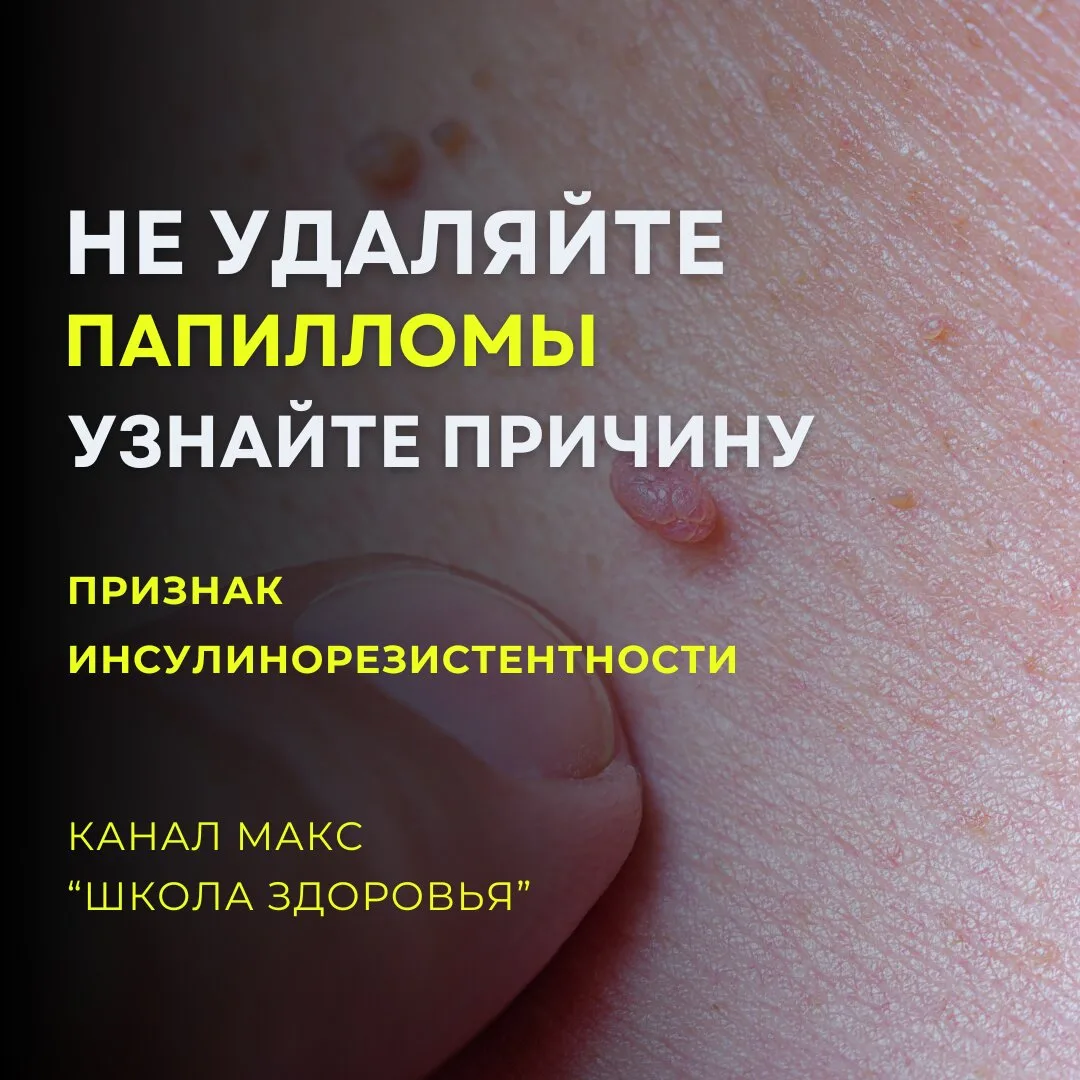 Как избавиться от полипов и папиллом? Без хирурга

Полипы и папилломы — это не просто «висит и мешае