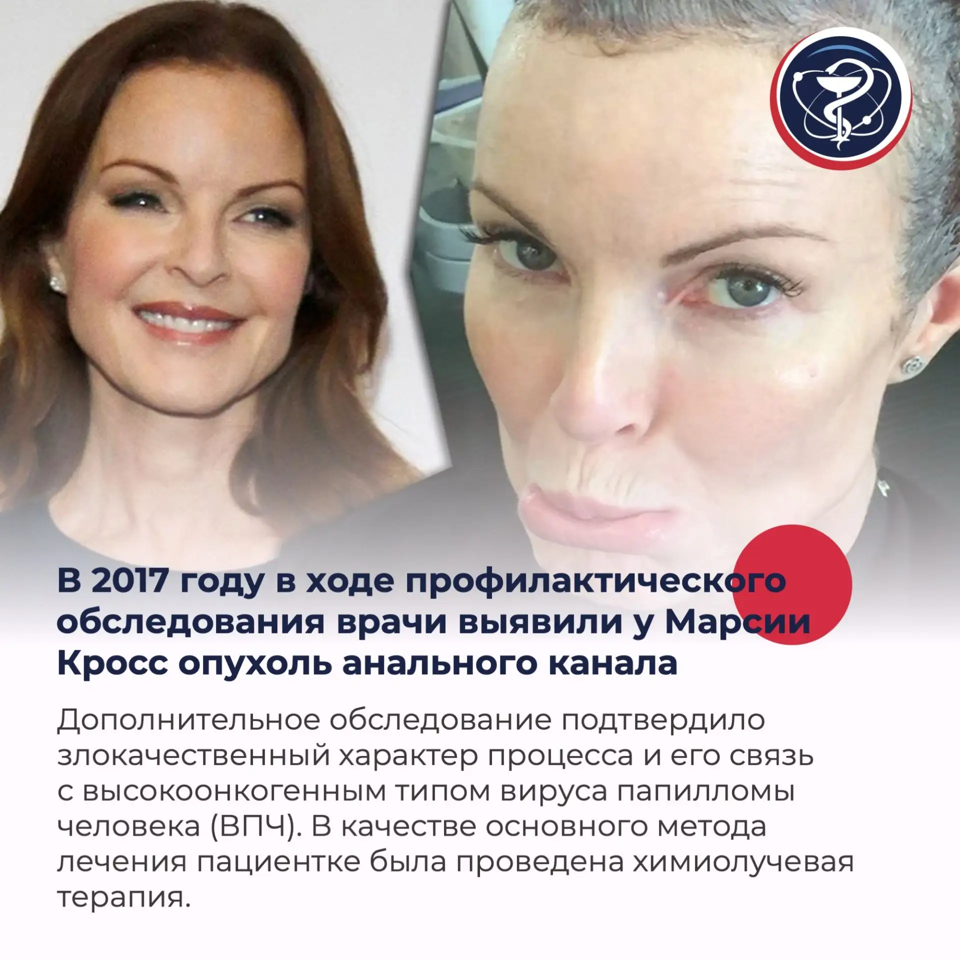 ЗВЕЗДЫ ПРОТИВ РАКА
Иногда истории знаменитостей помогают говорить о сложных медицинских темах горазд