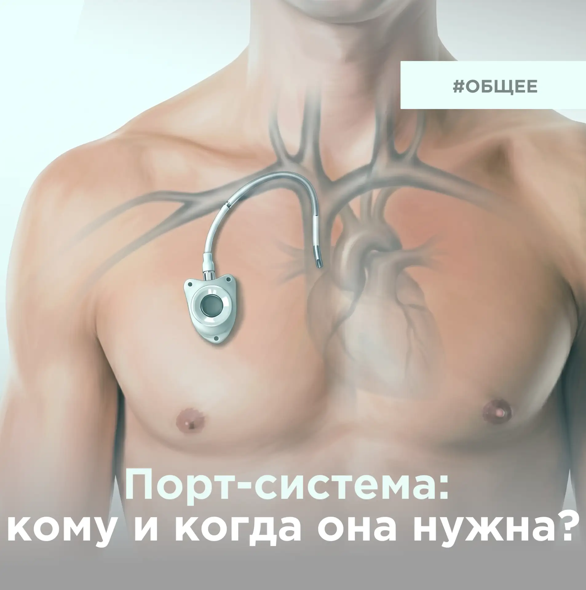 Порт-система: кому и когда она нужна?

Что такое порт-система?
Полностью имплантируемое под кожу уст