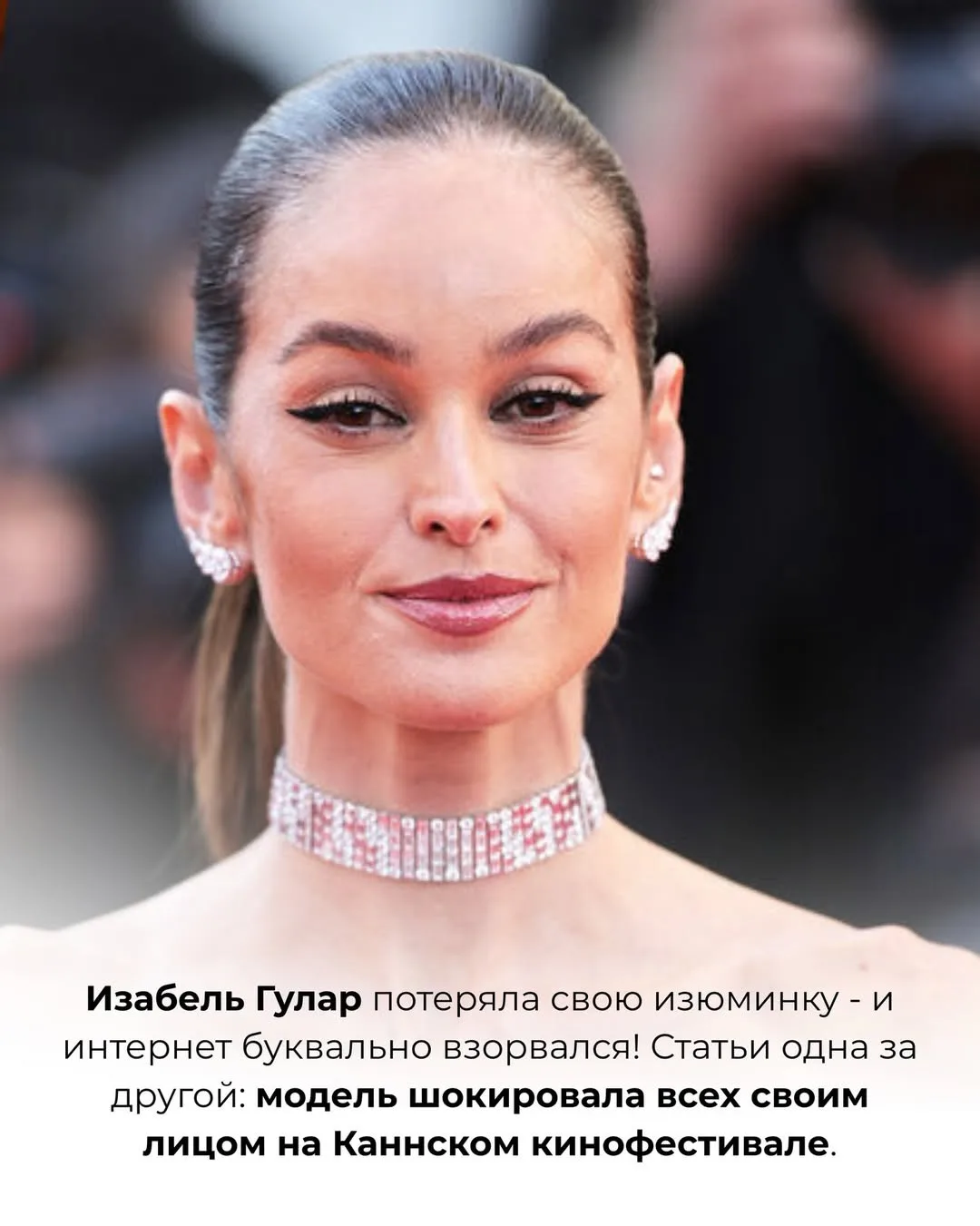 Пару лет назад среди хирургов появился тренд: вместо верхней блефаропластики всем подряд начали пред