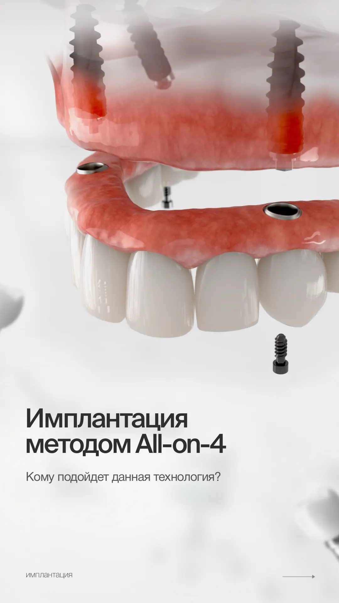 📌 ИМПЛАНТАЦИЯ ALL-ON-4