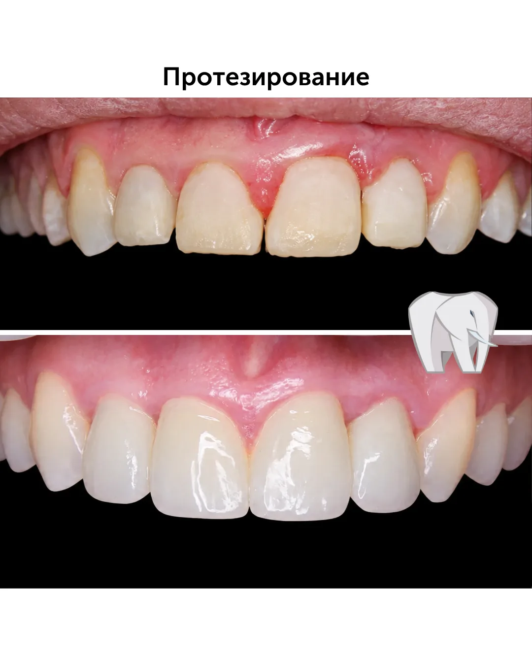 Длительная работа, сначала - ортодонтическое лечение, затем импланты и коронки. Протезирование выпол