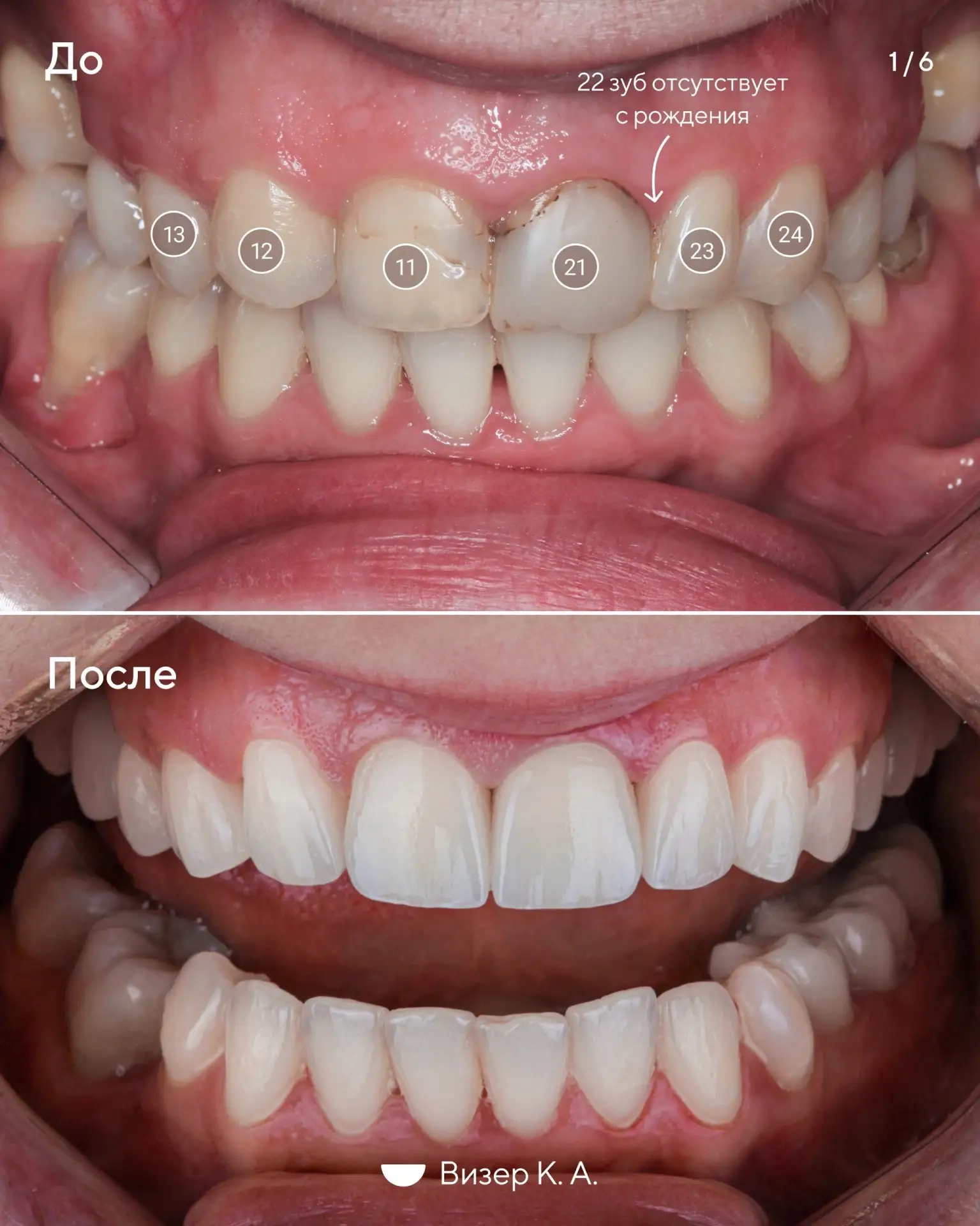 Что делать, если одного из передних зубов нет с рождения? 🦷